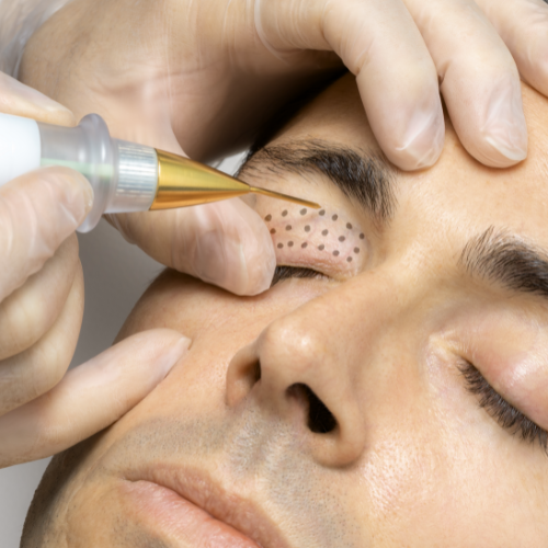 Remoção de sinais e verrugas